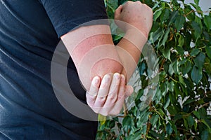 Pain in elbow concept photo. Person holds with palm of other hand over area of Ã¢â¬â¹Ã¢â¬â¹elbow due to occurrence of severe pain